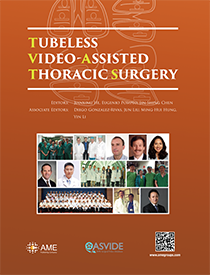 Tubeless Video-Assisted Thoracic Surgery
