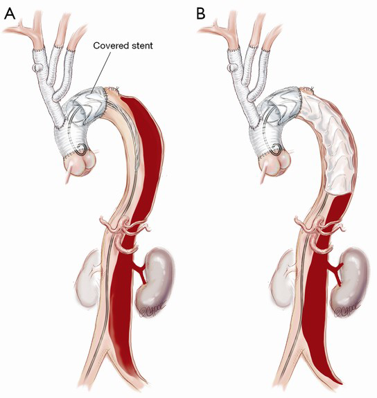Surgical management of acute type A aortic dissection: branch-first