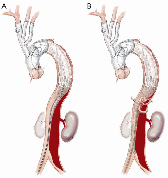 Surgical management of acute type A aortic dissection: branch-first