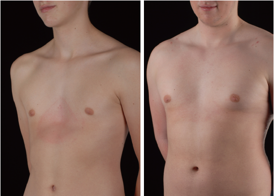 Vacuum Bell Therapy Haecker Annals Of Cardiothoracic Surgery