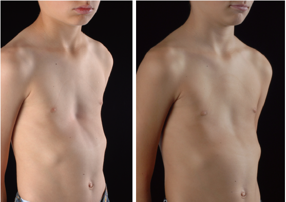 Vacuum Bell Therapy Haecker Annals Of Cardiothoracic Surgery