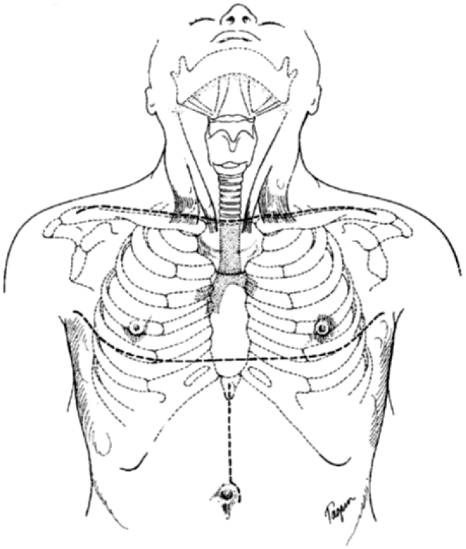 Cervical exenteration Sachdeva Annals of Cardiothoracic Surgery