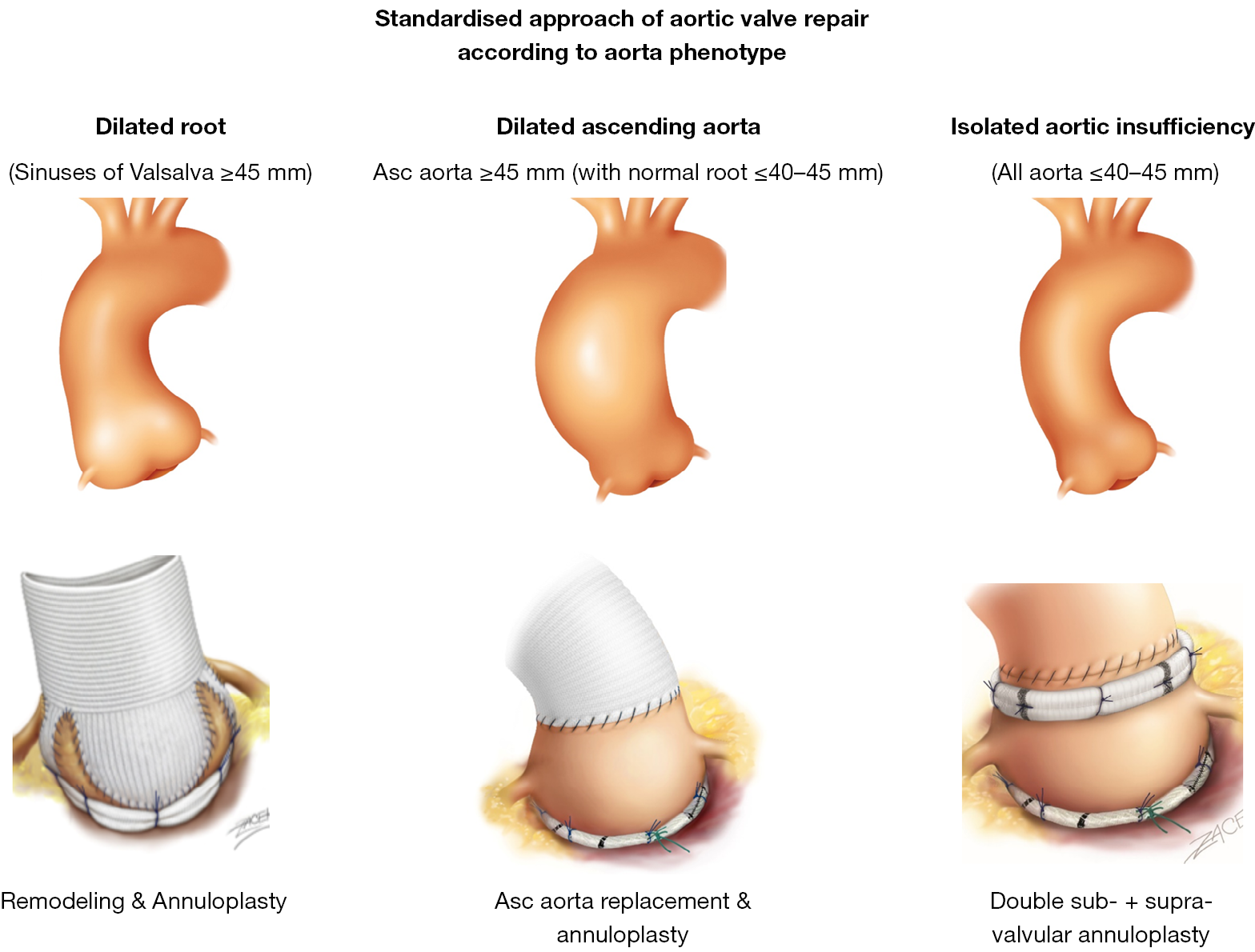 Rationale for aortic annuloplasty to standardise aortic valve repair
