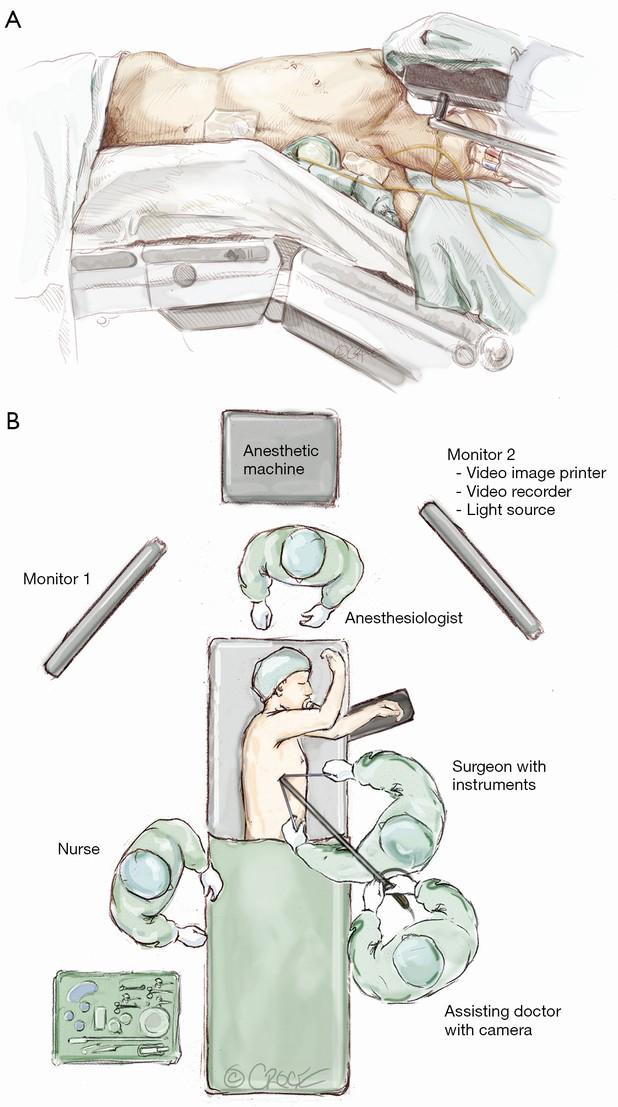 Uniportal videoassisted thoracoscopic lobectomy Sihoe Annals of