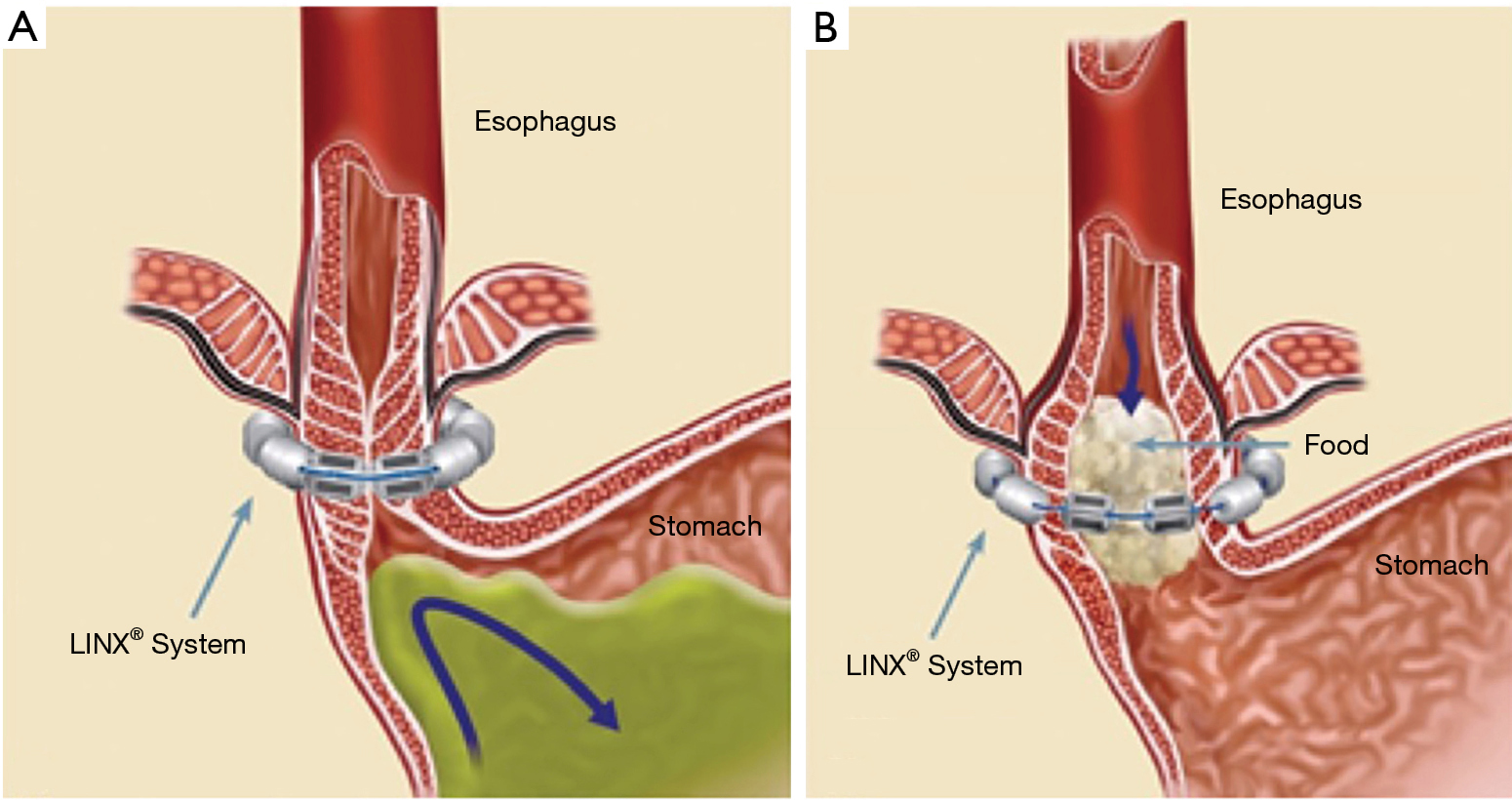 The Current Status Of Magnetic Sphincter Augmentation In The Management Of Gastroesophageal Reflux Disease Al Mansour Annals Of Laparoscopic And Endoscopic Surgery
