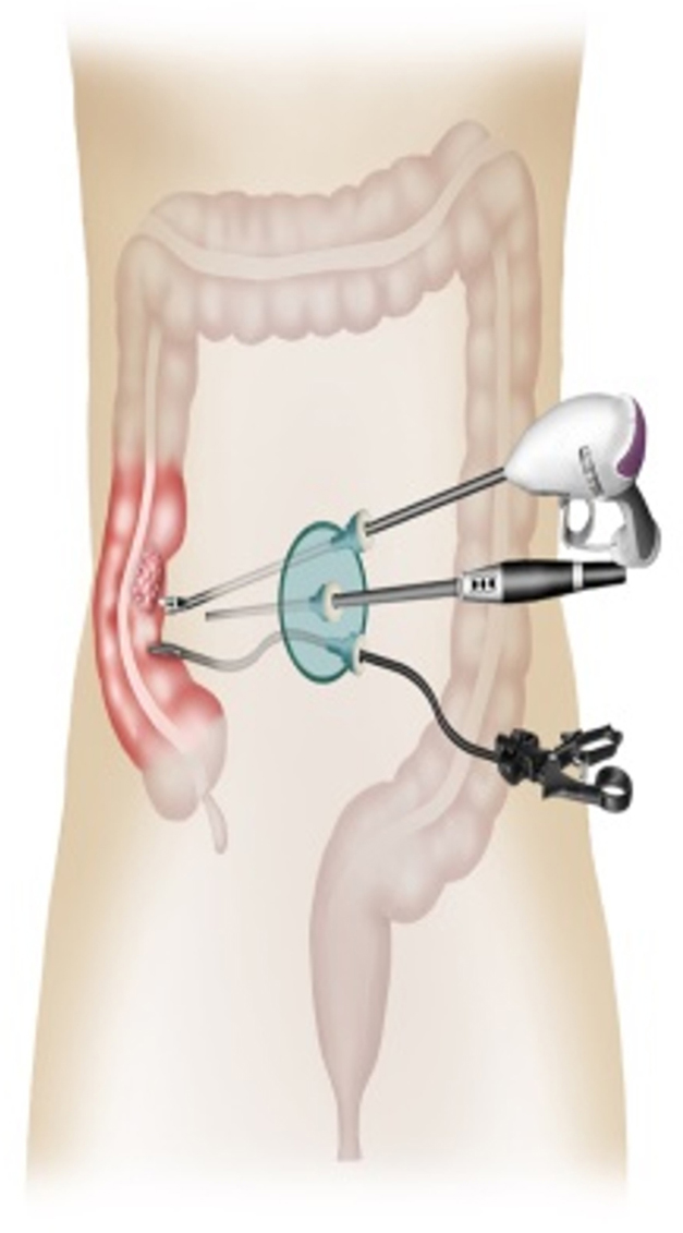 colectomy incision