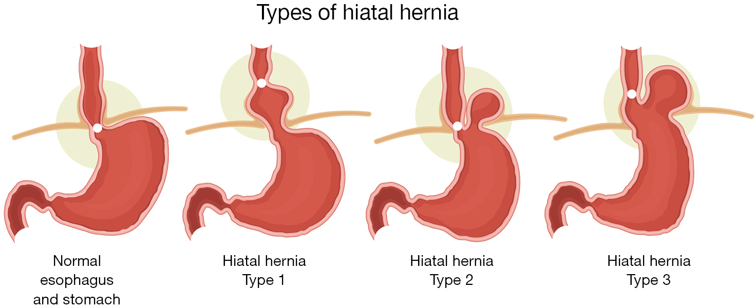 how to identify and correct a hiatal hernia part 1