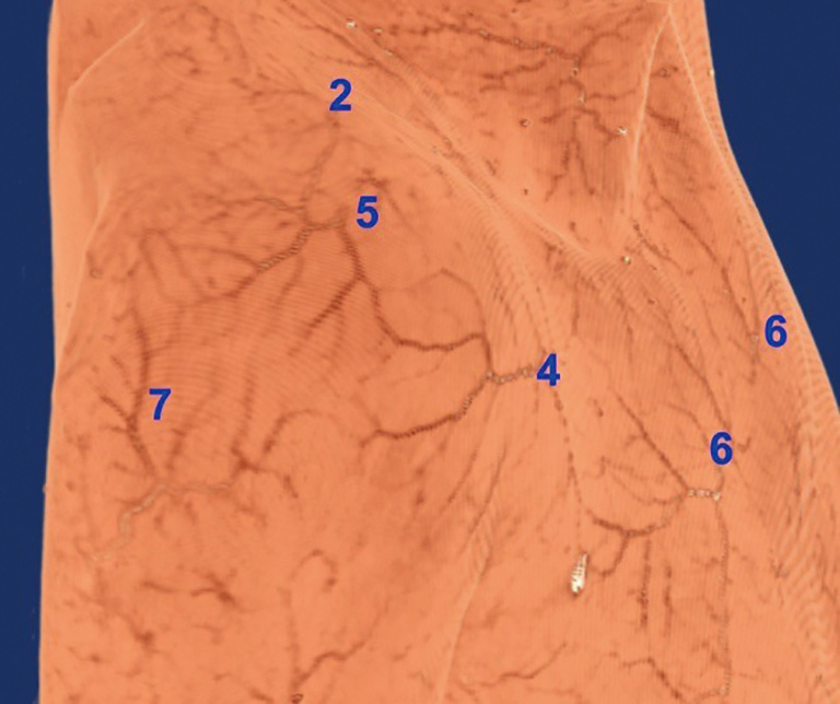 Anatomical basis of clavicular crossarea perforator flaps Jiang