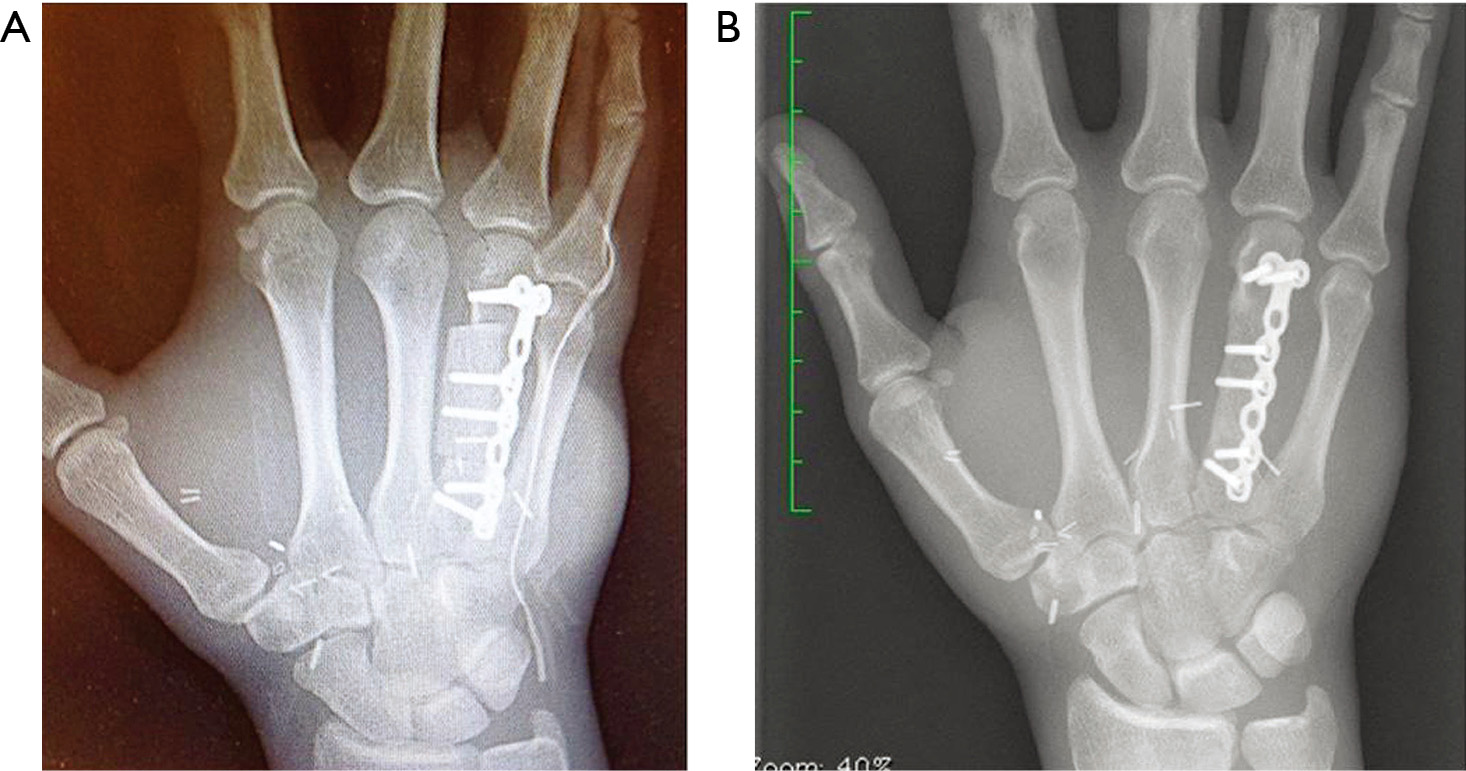 The chimeric lateral femoral condyle flap for reconstruction of a long