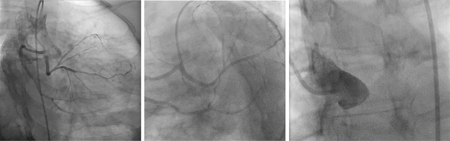 Anomalous origin of the left coronary artery from the right sinus an