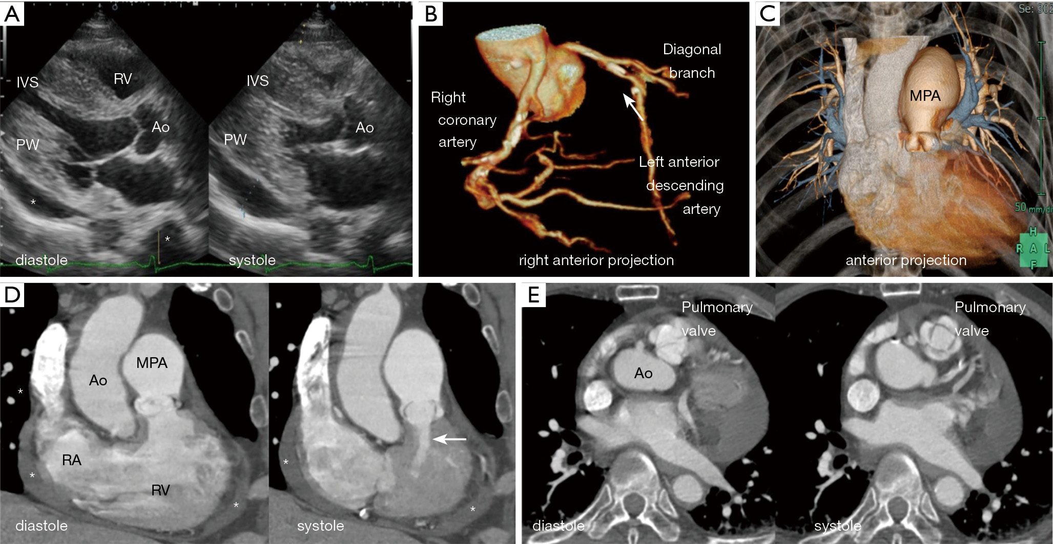 Coexistence of multiple congenital anomalies quadricuspid pulmonary