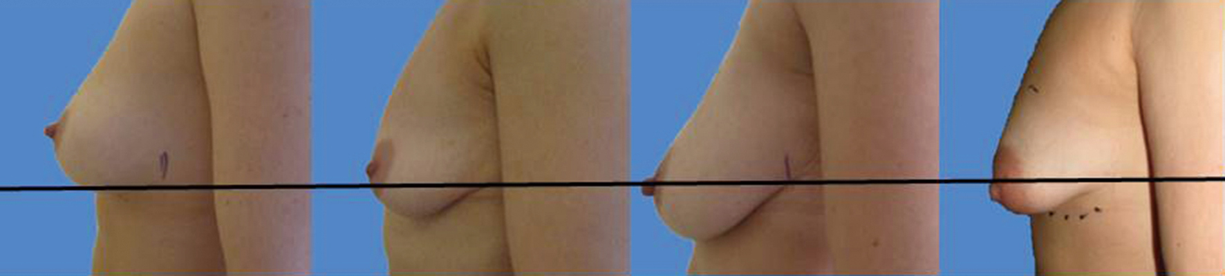 The Waterfall Effect In Breast Augmentation Frame Gland Surgery