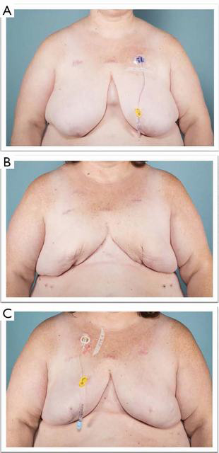 Aesthetic Goldilocks Mastectomy And Breast Reconstruction Promoting Its Use In The Ideal Candidate Oliver Gland Surgery