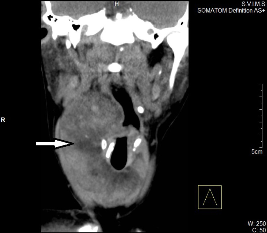 Thyrolipomatosis An Inquisitive Rare Entity Sanuvada Gland Surgery