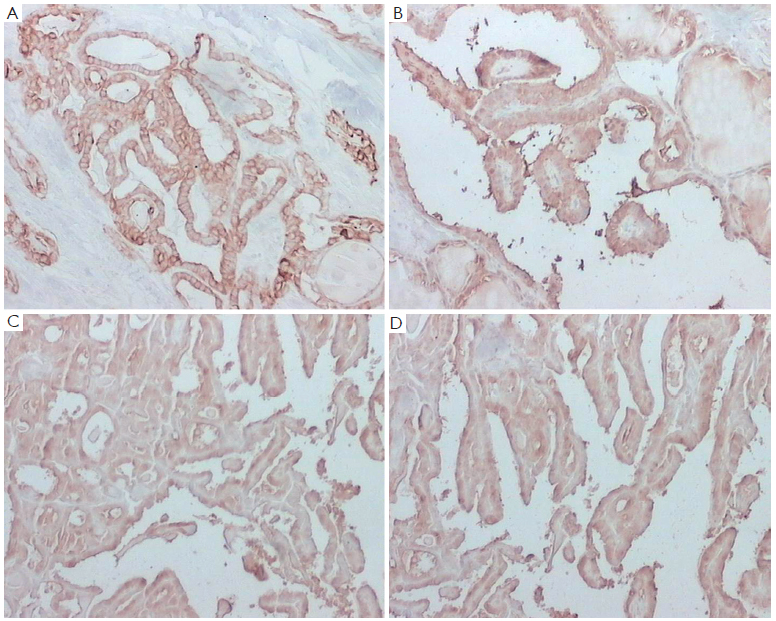 Expressions Of D2 40 Ck19 Galectin 3 Vegf And Egfr In Papillary Thyroid Carcinoma Gong Gland Surgery