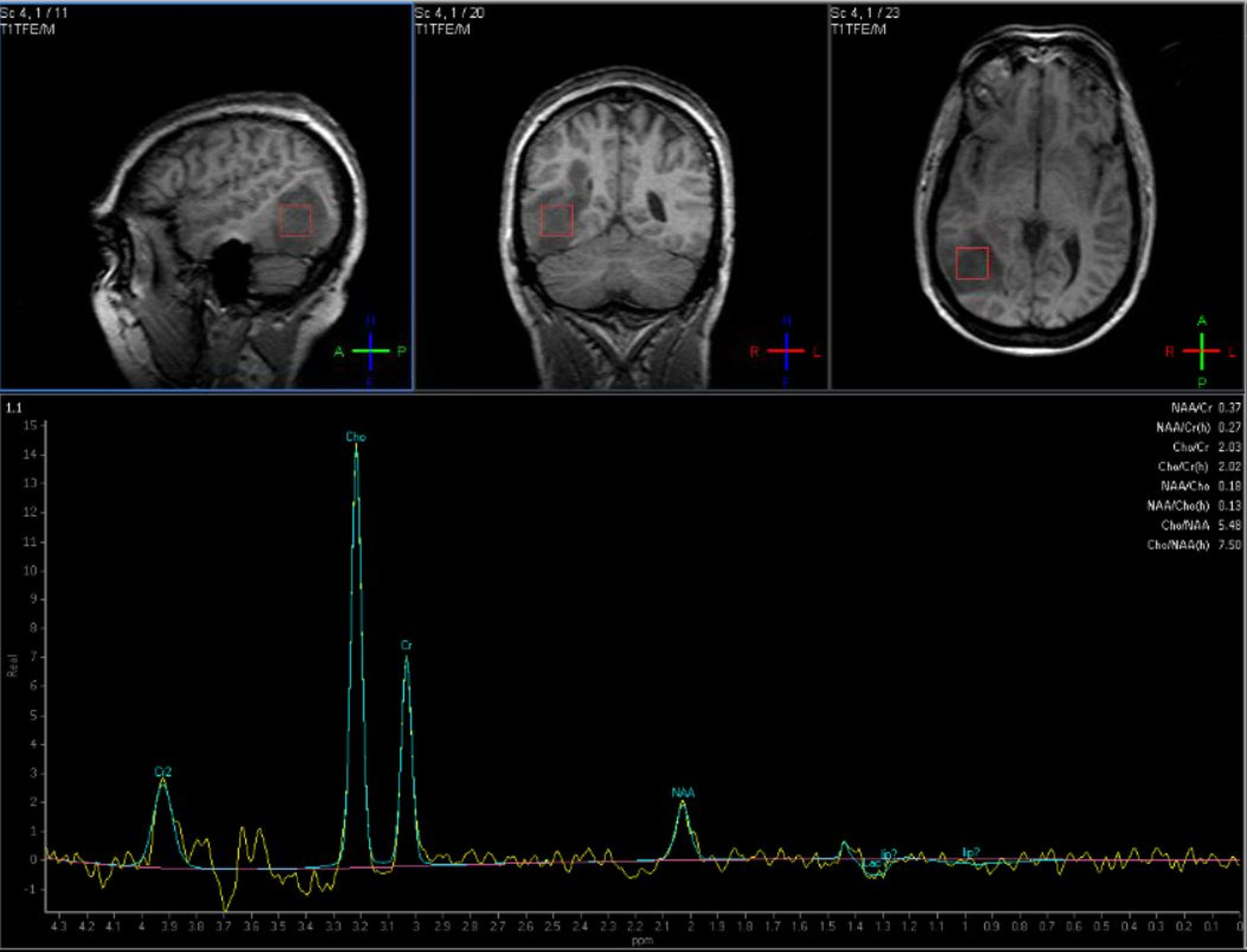 Advanced Magnetic Resonance Imaging In Glioblastoma A Review Shukla Chinese Clinical Oncology