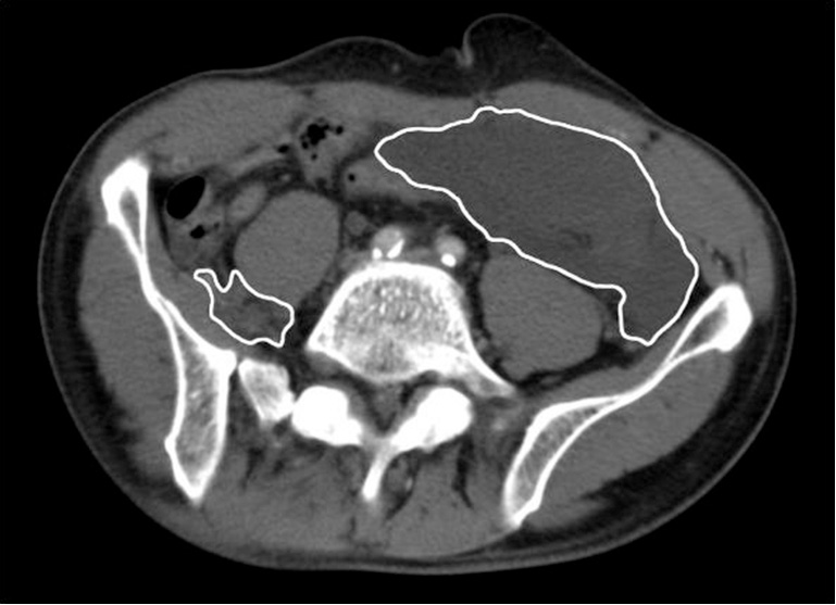 Blood loss in pelvic ring fractures: CT-based estimation ...