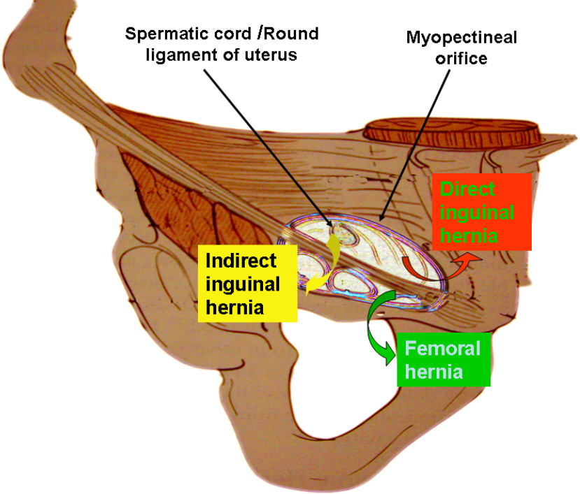 Anatomy Essentials For Laparoscopic Inguinal Hernia Repair Yang Annals Of Translational Medicine