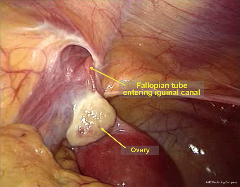 Laparoscopic Repair Of Inguinal Hernia In Adults Yang Annals Of Translational Medicine