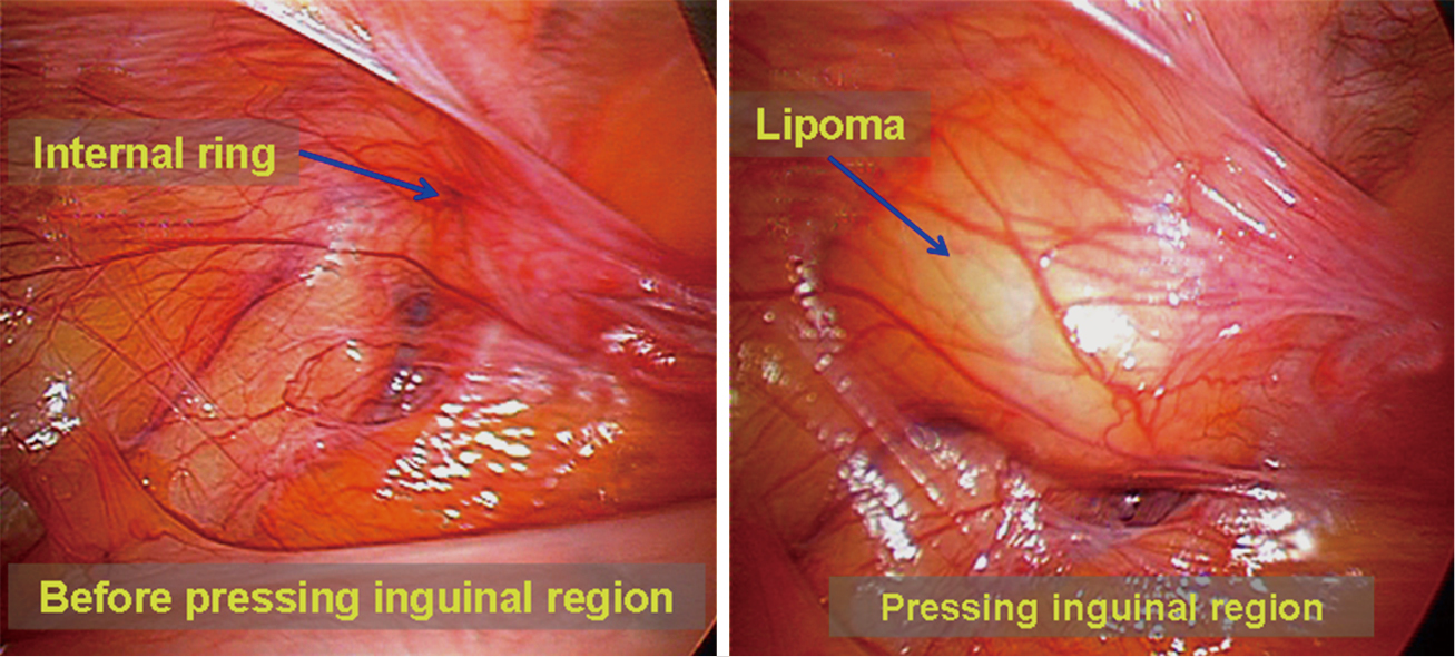 Laparoscopic Repair Of Inguinal Hernia In Adults Yang Annals Of Translational Medicine