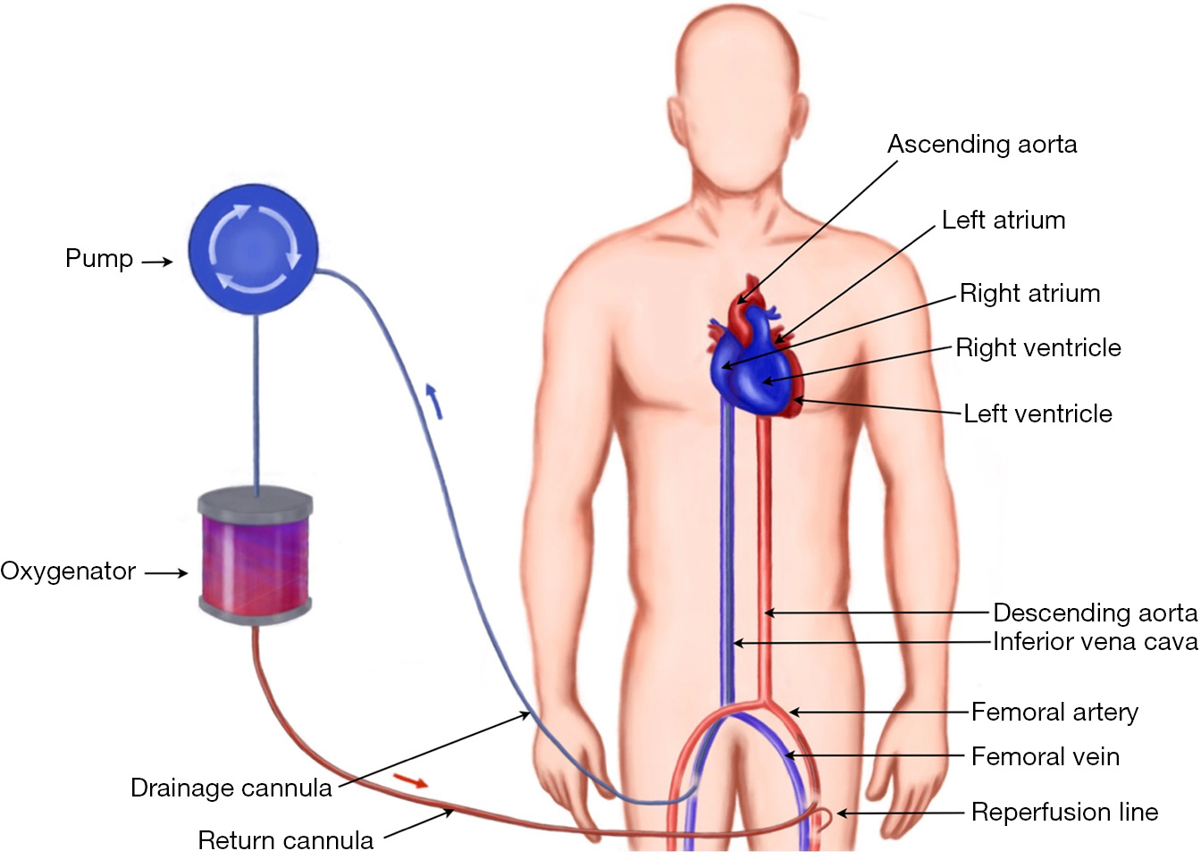 Cannulation techniques for extracorporeal life support - Pavlushkov