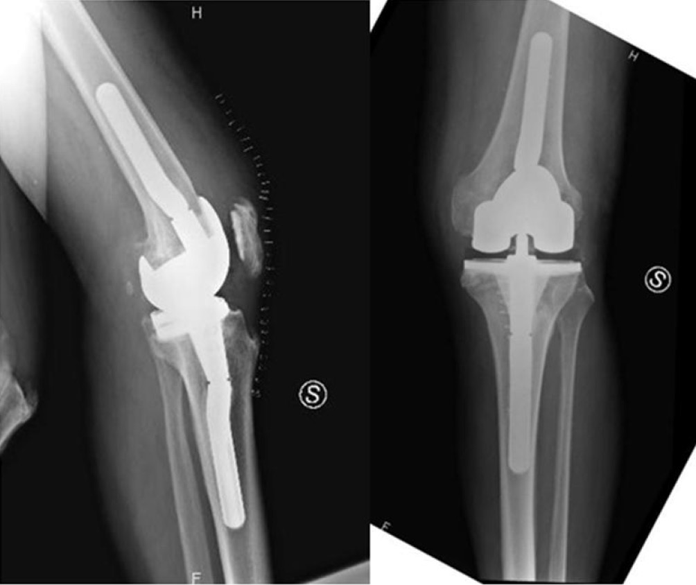 Condylar Constrained System In Primary Total Knee Replacement Our Experience And Literature Review Sabatini Annals Of Translational Medicine