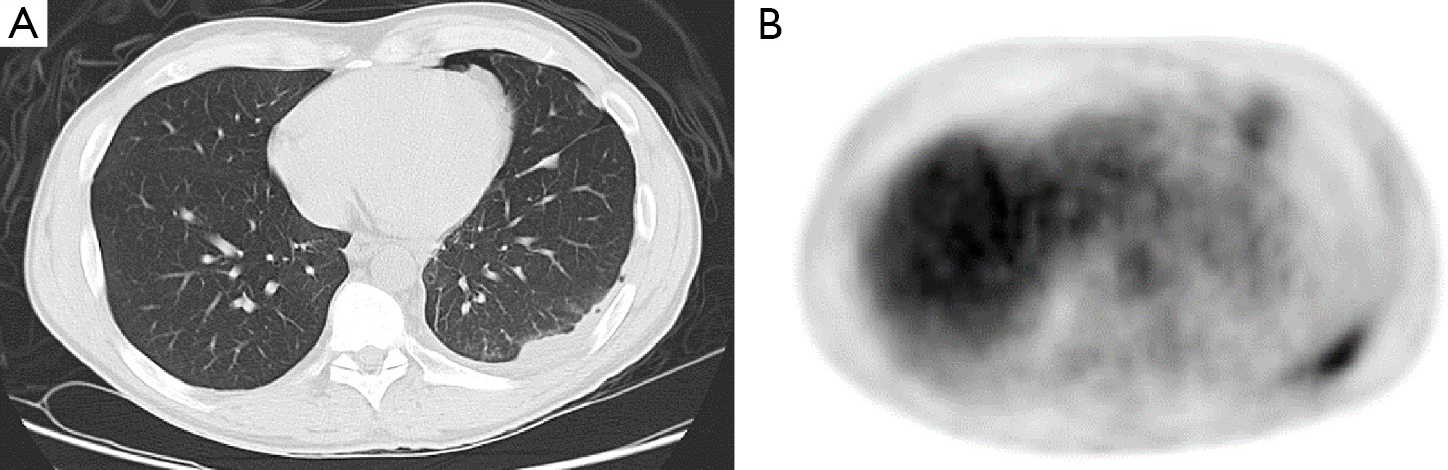 Malignant Pleural Mesothelioma Adjuvant Therapy With Radiation Therapy