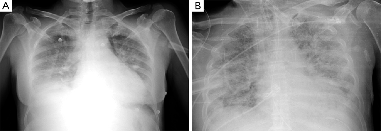 Lung Imaging How To Get Better Look Inside The Lung Ball Annals Of Translational Medicine