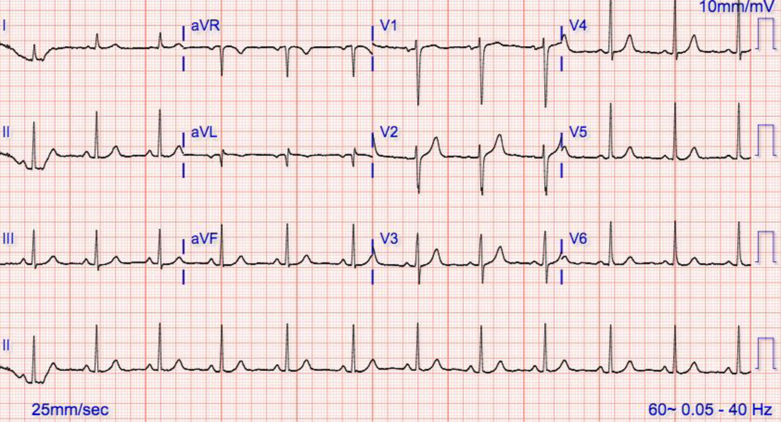 Electrocardiographic Artifact Potentially Misleading To The Wrong Management Sareen Annals Of Translational Medicine