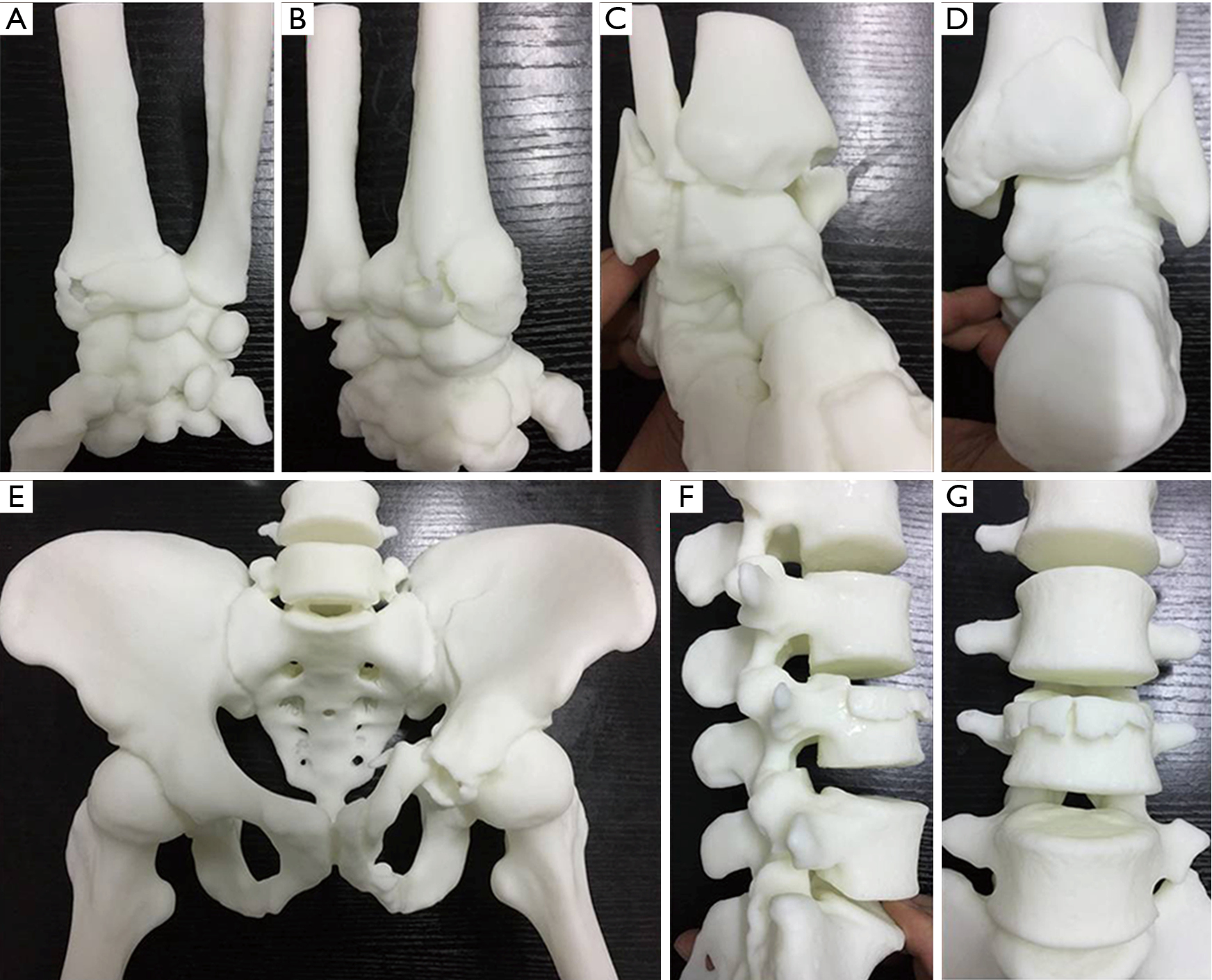 The Addition Of 3d Printed Models To Enhance The Teaching And Learning Of Bone Spatial Anatomy And Fractures For Undergraduate Students A Randomized Controlled Study Wu Annals Of Translational Medicine