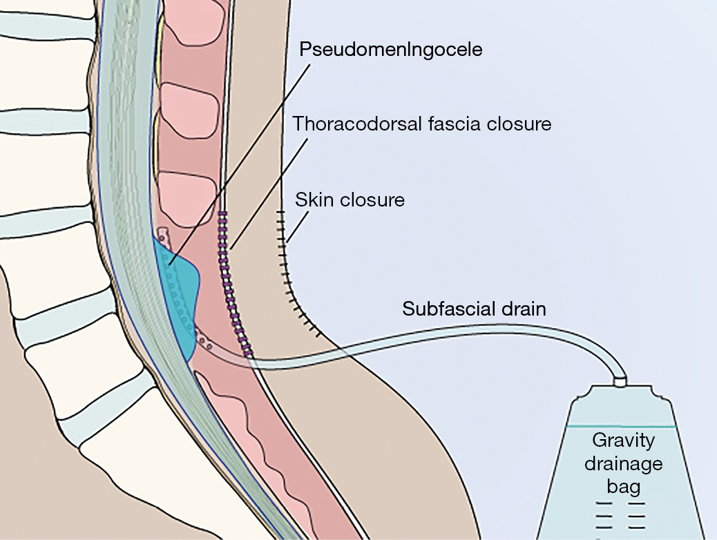 Lumbar Drain Removal Best Drain Photos