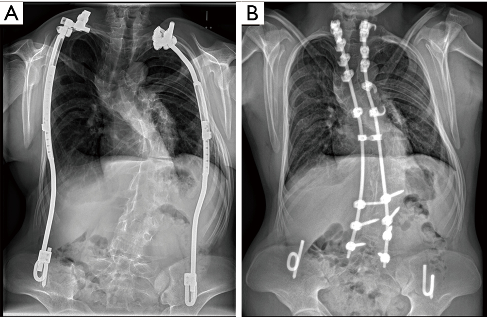 Long term of vertical expandable prosthetic titanium rib