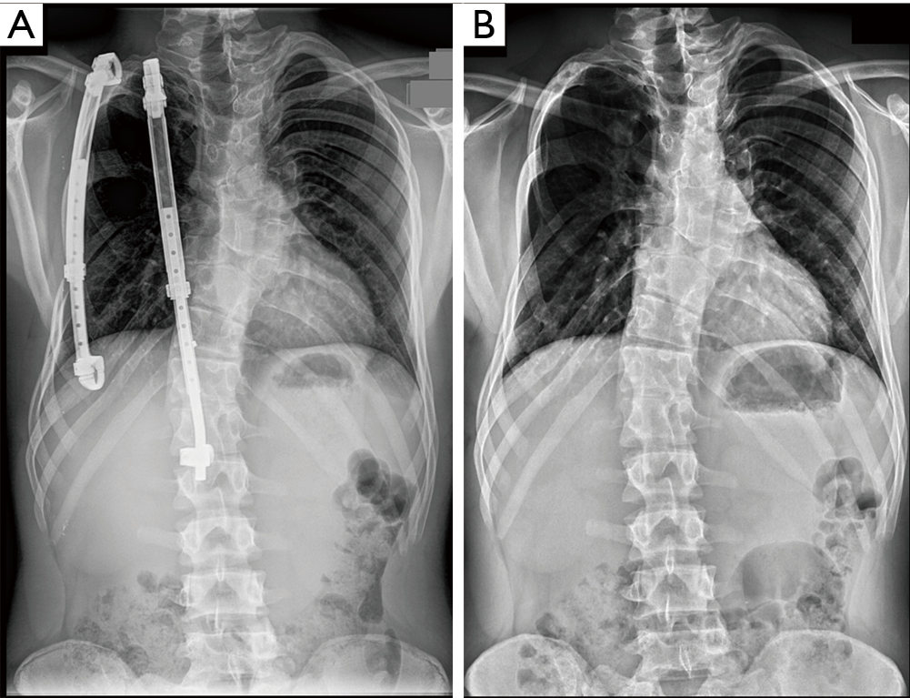 Long term of vertical expandable prosthetic titanium rib