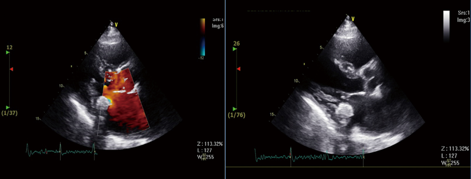 Caseous Calcification Of Posterior Mitral Annulus A Forgotten Benign