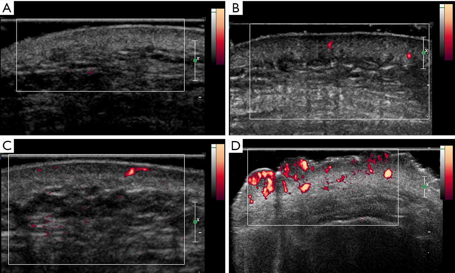 Quantification of skin lesions using highfrequency ultrasound and