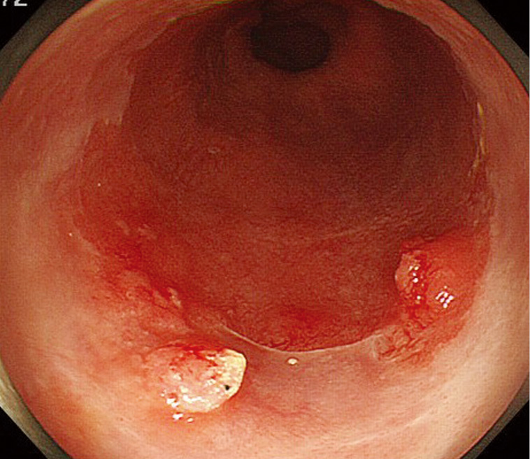 Endoscopic Submucosal Dissection For Superficial Barrett S Esophageal Cancer In The Japanese State And Perspective Ishihara Annals Of Translational Medicine
