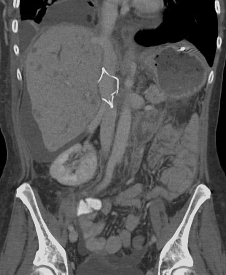 When Is Cordis Ivc Filter Going To Court prntbl