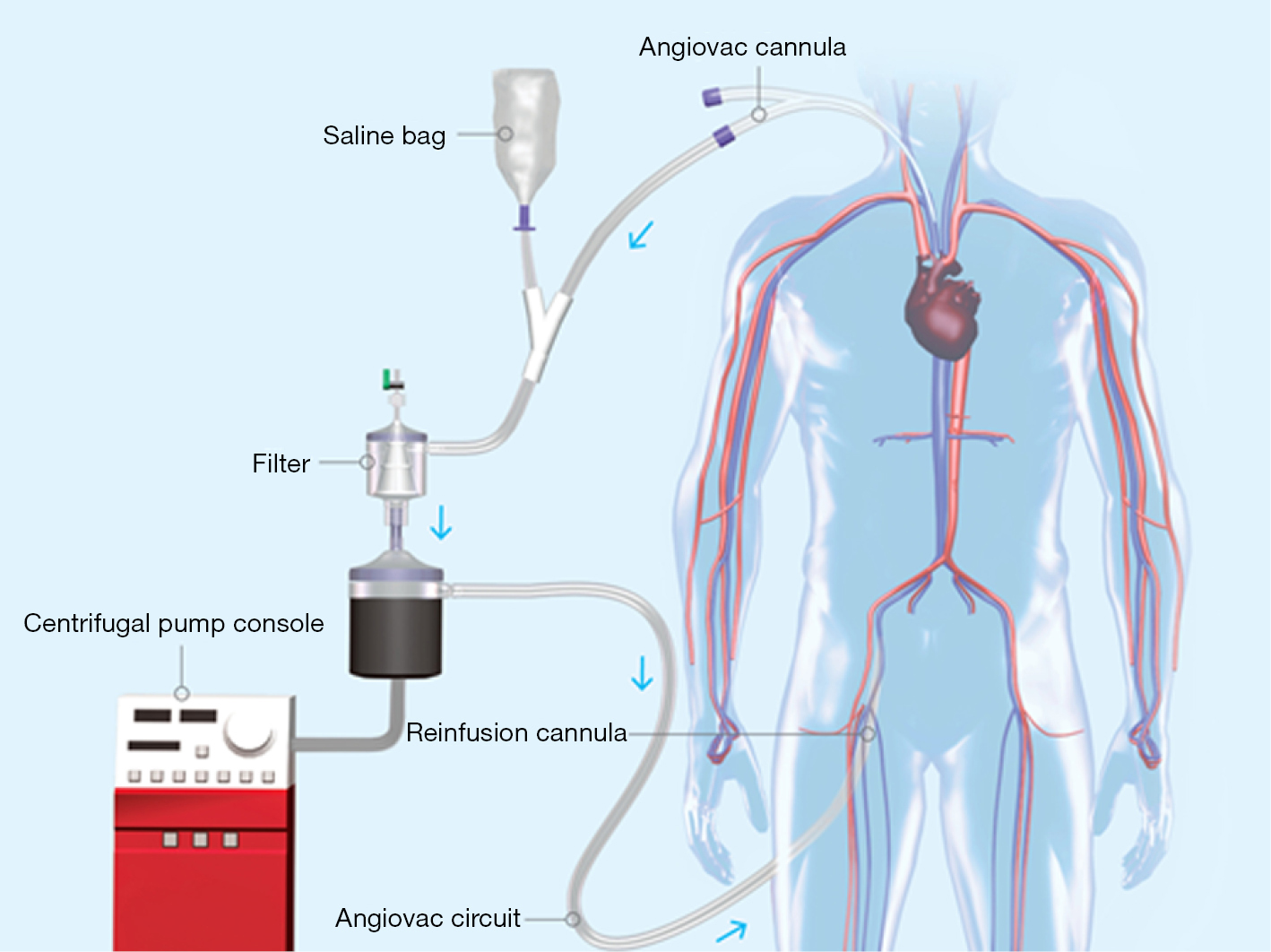 Catheter directed interventions for acute deep vein thrombosis Kohi
