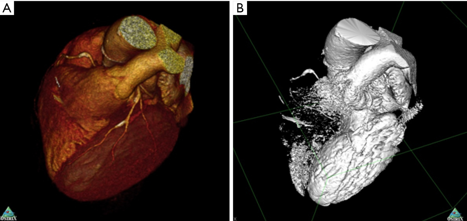 3D Printing From Cardiovascular Ct A Practical Guide And Review  - Soon Thereafter, Datasets From Computed Tomography (Ct) Or Magnetic Resonance Imaging (Mri) Were Used To Produce 3D Cardiac Models Of 3D Printing Technology And Options For Cardiovascular Printing.