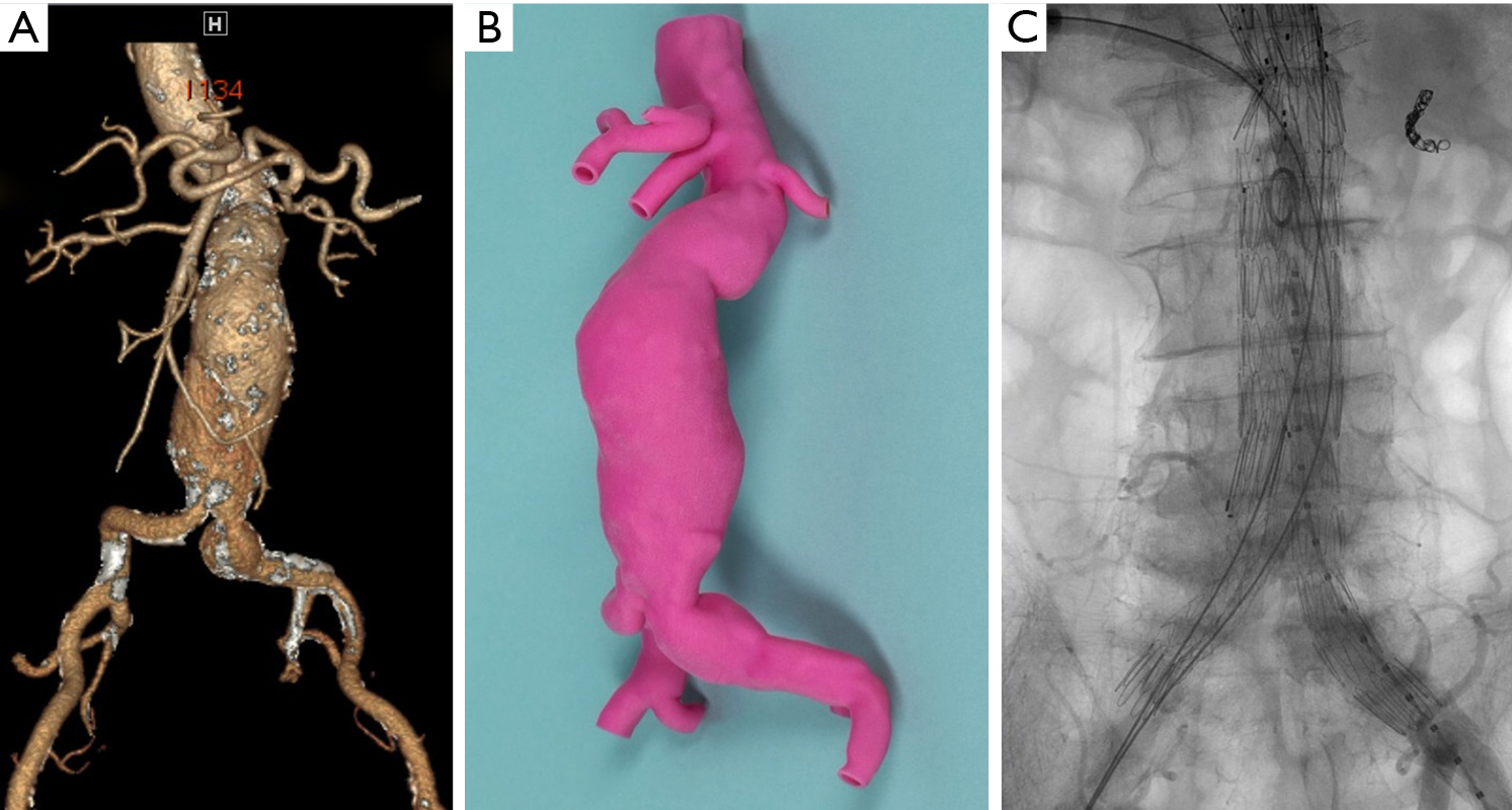 Three Dimensional 3d Printing And Its Applications For Aortic Diseases Hangge Cardiovascular Diagnosis And Therapy