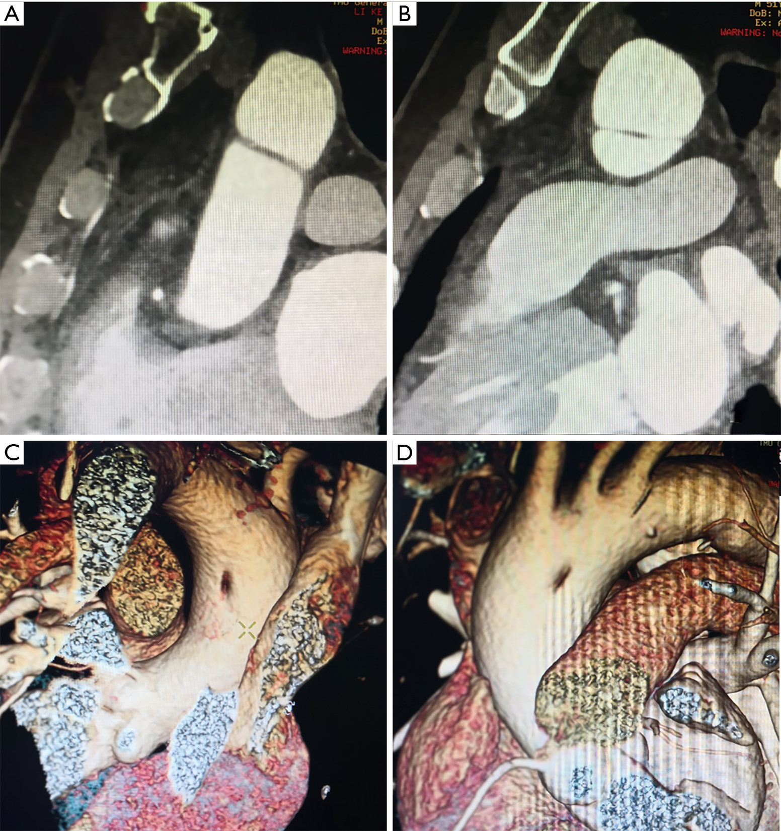 Intraluminal fibrous cord of the aorta in the differential diagnosis of