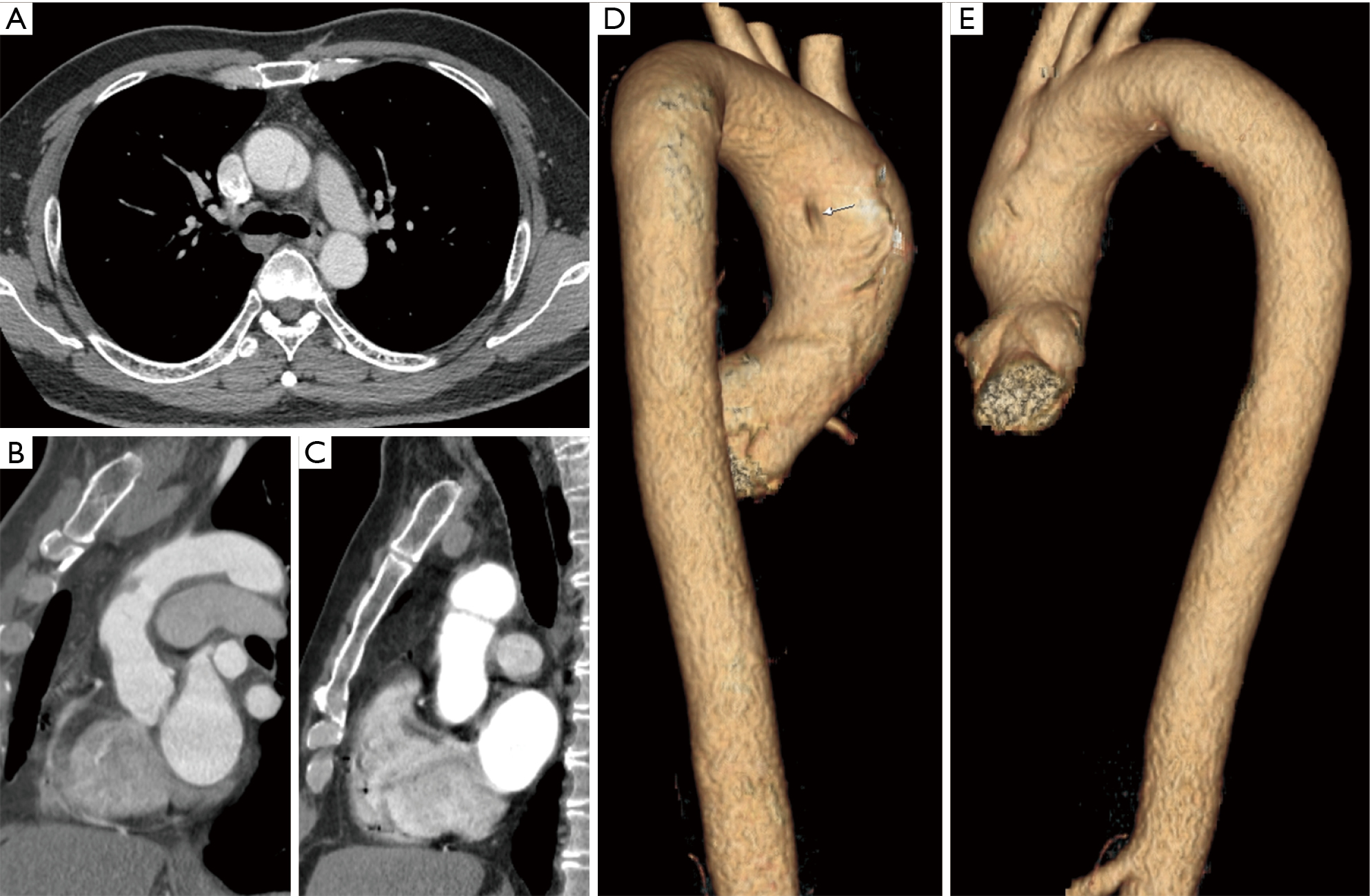 Intraluminal fibrous cord of the aorta in the differential diagnosis of