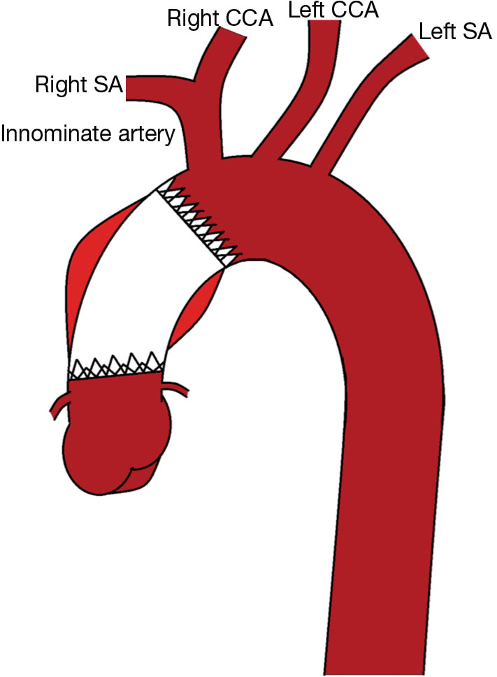 Stenting In Type A Aortic Dissection Fantasy Or Reality Harky Journal Of Visualized Surgery