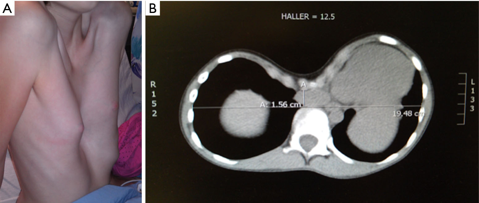 Minimally Invasive Repair Of Pectus Excavatum Hebra Journal Of Visualized Surgery