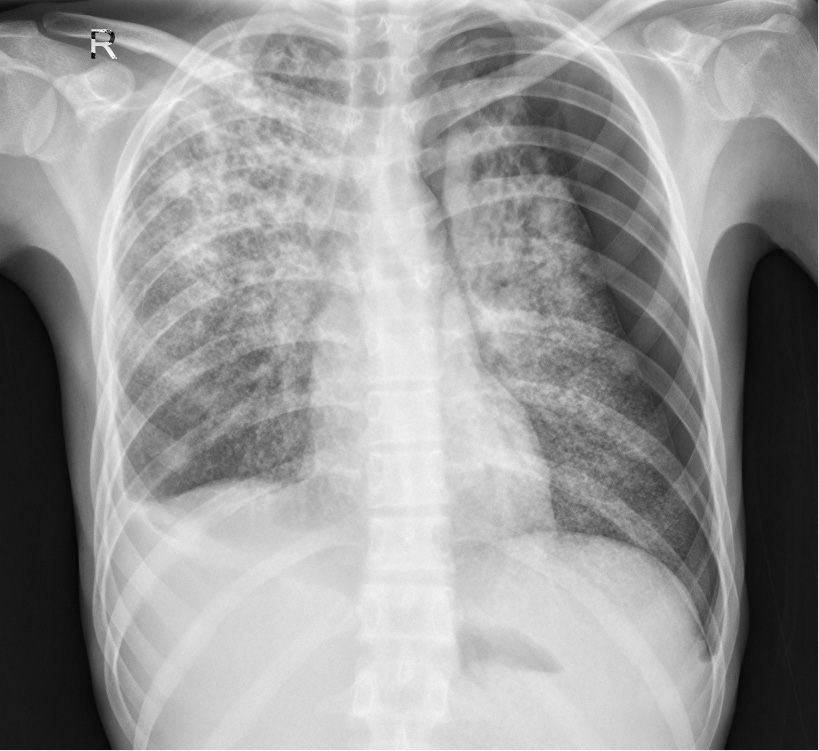 Pavingstone CT finding in a pulmonary tuberculosis patient Huang