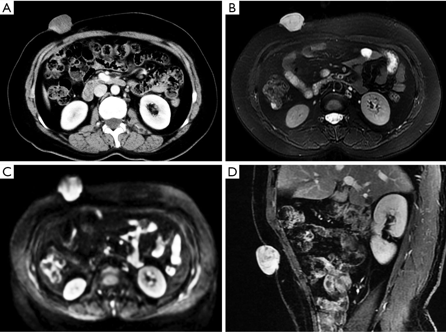 Ct And Mri Features Of Tumors And Tumor Like Lesions In The Abdominal Wall Li Quantitative Imaging In Medicine And Surgery