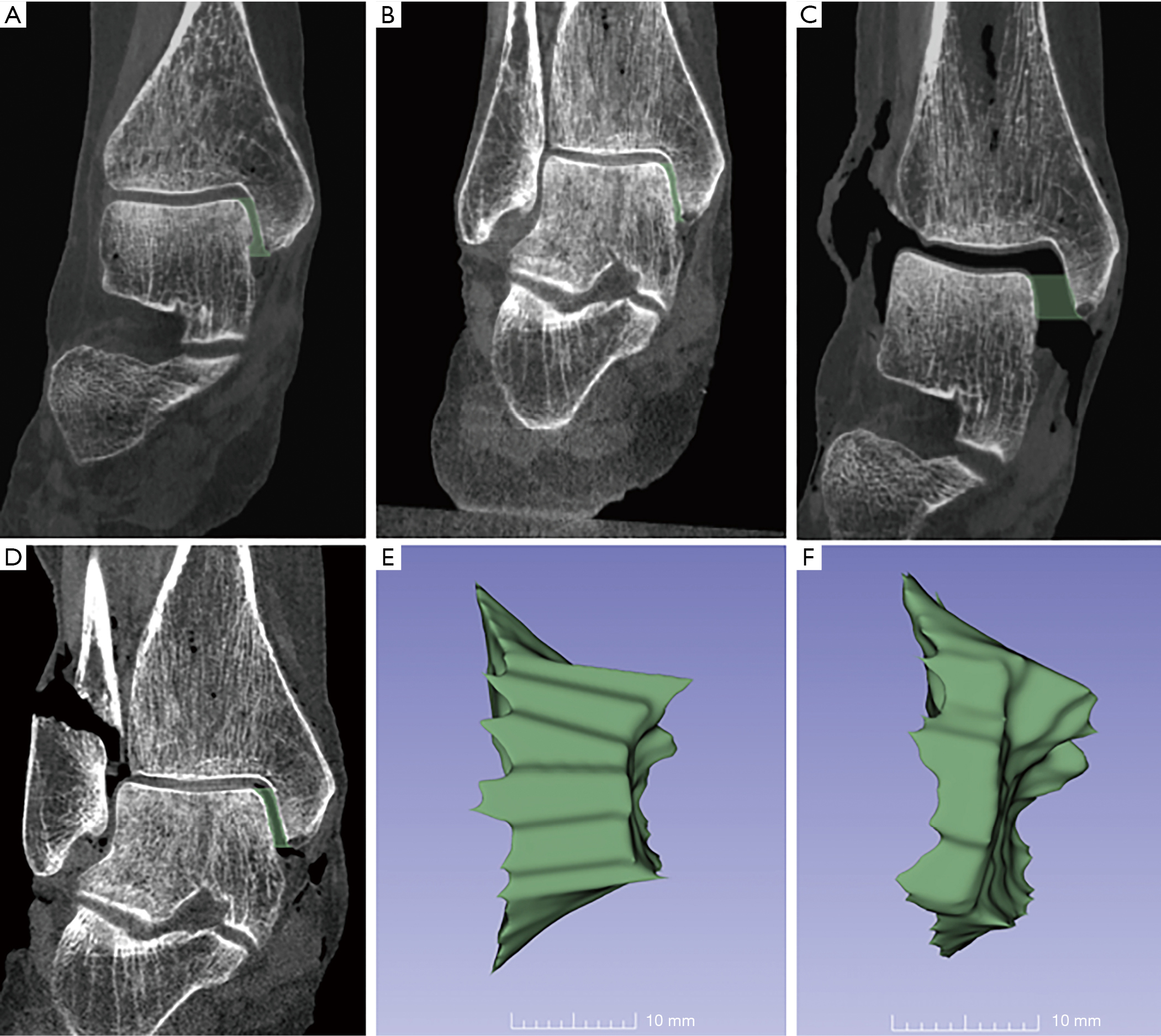 Medial Clear Space Volume On Cone Beam Ct Scan Offers Objective Measurement Of Congruency In Supination External Rotation Ankle Fractures In A Cadaver Model Lawlor Quantitative Imaging In Medicine And Surgery