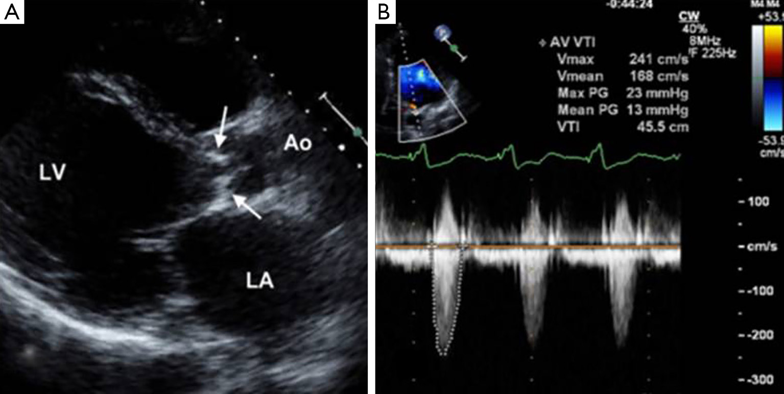 Multi Detector Ct Angiography Of The Aortic Valve—part 1