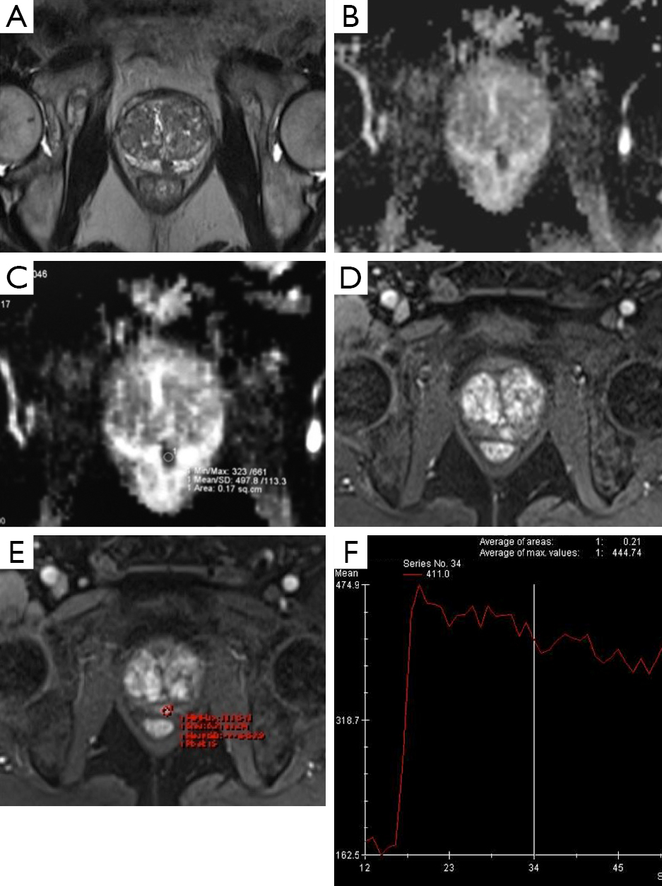 Current role of multiparametric resonance imaging for prostate cancer Loffroy