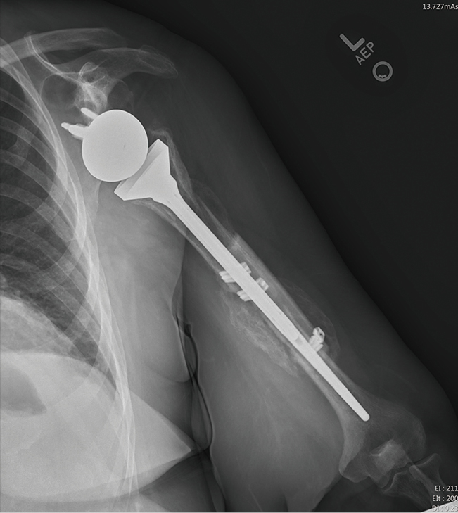 Periprosthetic Humerus Fractures Classification Management And